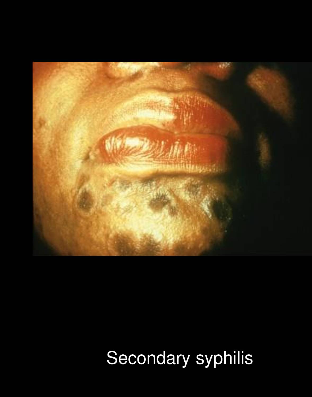 Syphilitic lymphadenopathy showing enlarged firm non-tender epitrochlear lymph nodes in secondary syphilis caused by Treponema pallidum